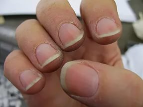 Воспаление кожи вокруг ногтя на руке: лечение паронихии, причины и диагностика воспаления кутикулы